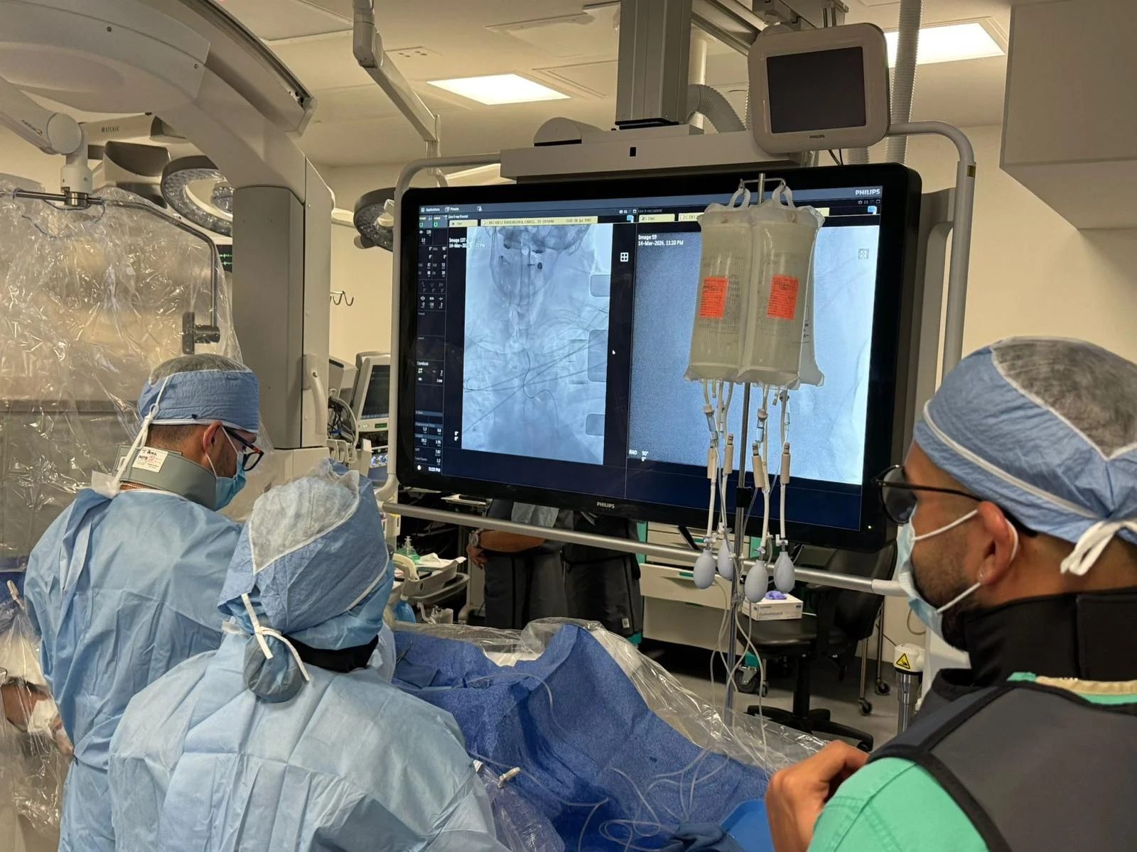 Trombectomía cerebral amplía las opciones de tratamiento en emergencias cerebrovasculares